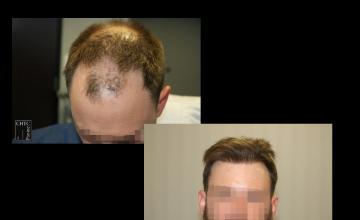 PANINE, MD | Chicago Hair Transplant Clinic - 2 FUE Procedures 4,750 Grafts