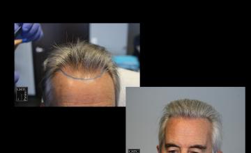 PANINE, MD | Chicago Hair Transplant Clinic | 2,000 Graft FUT Hair Transplant | 18 Months Post-Op