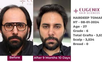 Eugenix Hair Sciences | NW 6 | 3,534 Grafts | 9 Months Hair Transplant Results| Dr. Pradeep Sethi