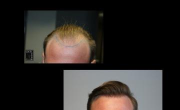 PANINE, MD | CHICAGO HAIR TRANSPLANT CLINIC | 2,814 Graft FUE Hair Transplant Results @18 Months Post-Op