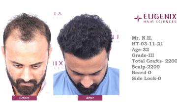 Eugenix Hair Sciences Clinic | Norwood Grade 3 | 22 Months Hair Transplant Results| Dr. Priyadarshini Das