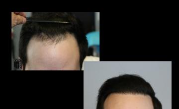 PANINE, MD | Chicago Hair Transplant Clinic | FUE Hair Transplant with 2,572 Grafts After One Year