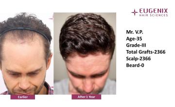 Dr. Arika Bansal | Eugenix Hair Sciences Clinic | 12 Months Hair Transplant Results | NW3 | 2,366 Grafts