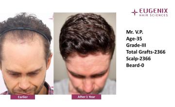Dr. Arika Bansal | Eugenix Hair Sciences Clinic | 12 Months Hair Transplant Results | NW3 | 2,366 Grafts