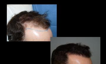 PANINE, MD | Chicago Hair Transplant Clinic | FUE Hair Transplant Results with 2,420 Grafts | 1 Week, 1 Month and 10 Months Post-Op