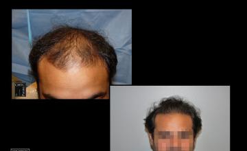 PANINE, MD - Chicago Hair Transplant Clinic - FUT Hair Transplant Results with 3,602 Grafts