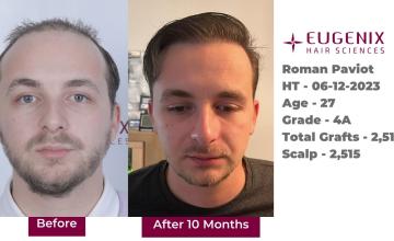 Eugenix Hair Sciences | Norwood Grade 4 | 10 Months Hair Transplant Results | Dr. Arika Bansal