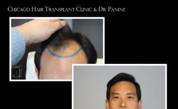 PANINE, MD | CHICAGO HAIR TRANSPLANT CLINIC - FUT Hair Restoration Surgery - 3,538 Grafts