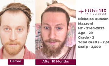 Eugenix Hair Sciences | Norwood Grade 2 | 10 Months Hair Transplant Results | 2500 Grafts | Dr. Arika Bansal