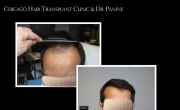 PANINE, MD - Chicago Hair Transplant Clinic Patient Results 14 Months After Surgery