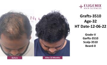 Eugenix Hair Sciences Clinic | Norwood Grade 5 | 10 Months Hair Transplant Results | 3510 Grafts | Dr. Somesh