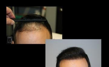 PANINE, MD | Chicago Hair Transplant Clinic - FUE Hair Transplant Results with 2,049 Grafts | One Year Post-Op
