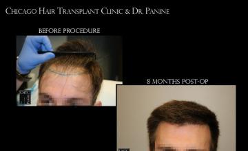 PANINE, MD | CHICAGO HAIR TRANSPLANT CLINIC - FUE Hair Transplant Result 2,880 Grafts