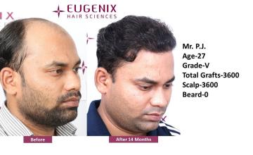 Hair Transplant Before and After