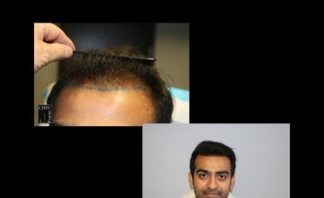 PANINE, MD | Chicago Hair Transplant Clinic | 2,400 Graft FUE Hair Transplant Before and After Photos at 11 Months Post-Op