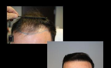 PANINE, MD | Chicago Hair Transplant Clinic | Results of FUE Hair Transplant with 2,678 Grafts After 1 Year