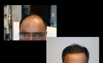 PANINE, MD | Chicago Hair Transplant Clinic | 2,800 Graft FUE Hair Transplant | 8 Month Post-Op
