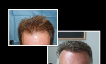 PANINE, MD & Chicago Hair Transplant Clinic | Two Procedures | FUT & FUE Surgery