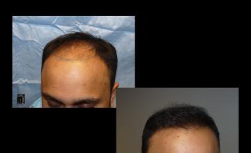 PANINE, MD & Chicago Hair Transplant Clinic - 3,553 Grafts | FUT Hair Restoration Patient's Results After 8 Months