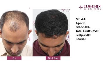 Dr. Arika Bansal | Eugenix Hair Sciences Clinic | 18 Months Hair Transplant Results | NW3A | 2,508 Grafts