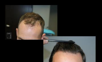 PANINE, MD | Chicago Hair Transplant Clinic | 2,800 Graft FUE Hair Transplant Results After One Year