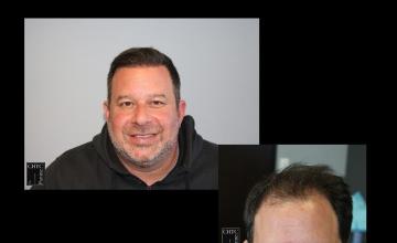 PANINE, MD | Chicago Hair Transplant Clinic | Results of a 2,717 Graft FUE Hair Transplant One Year After Surgery