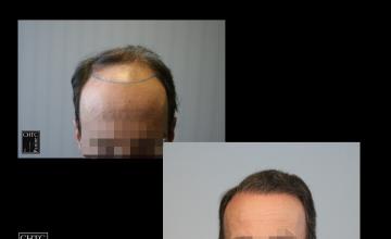 PANINE, MD | Chicago Hair Transplant Clinic - FUE Hair Transplant Results with 2,815 Grafts