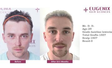 Eugenix Hair Sciences | 1,507 Grafts | 10.5 Months Post-op| Dr. Priyadarshini Das