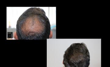PANINE, MD | Chicago Hair Transplant Clinic - Vertex/Crown FUE Hair Transplant w/ 2,448 Grafts After 10 Days/1 Year
