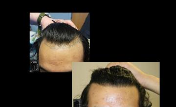 PANINE, MD | Chicago Hair Transplant Clinic | 2,500 Graft FUE Hair Transplant at Three Weeks & One Year