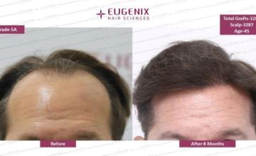 Caucasian Hair: 6 months update @Eugenix Hair Sciences