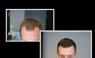 PANINE, MD | Chicago Hair Transplant Clinic - 3,071 Graft Hair Transplant (FUT)