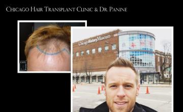 PANINE, MD | CHICAGO HAIR TRANSPLANT CLINIC - FUE Patient Results