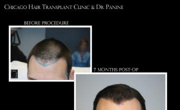 Chicago Hair Transplant Clinic & PANINE, MD - FUE Hair Transplant w/ 2,050 Grafts