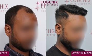 Eugenix Hair Sciences | NW 3A | 2,634 Grafts | 10 Months Hair Transplant Results