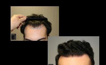 PANINE, MD | Chicago Hair Transplant Clinic | Results of a 2,300 Graft FUE Hair Transplant After 1 Year