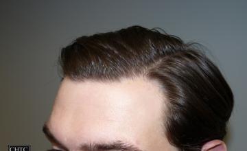 PANINE, MD - Chicago Hair Transplant Clinic - Results with 4,300 FUT Grafts at 4, 8, 12 and 24 Months