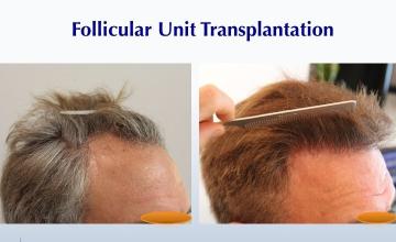 Can I Color My Hair Afterwards? (3080 grafts): Carlos K. Wesley, M.D. (NYC & LA)