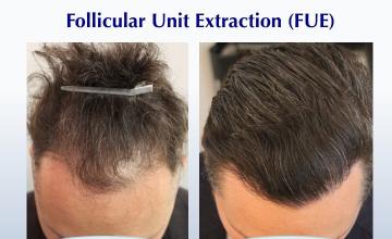 Can FUE Produce a Dense Hairline? (2600 FUE grafts): Carlos K. Wesley, M.D. (NYC & LA)