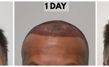3021 Grafts (6177 Hairs) FUE Hair Transplant with Dr. Rahal