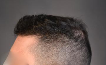 2515 Graft FUE | Dr. Arocha | 15 month results