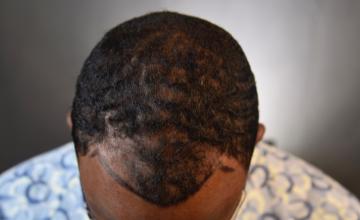 Dr. Arocha - African American 2000 Graft FUE - 7 month results