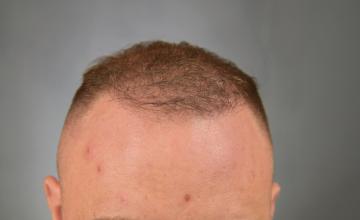 Dr. Arocha | Two 1,000 graft FUE Procedures + SMP
