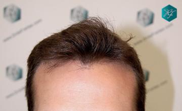 Dr. Rafael De Freitas - 2.311 Grafts - 5.504 Hairs - FUE