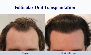 #BAM Hairline and Temples + a Light Crown Coverage (2898 FUT grafts): Carlos K. Wesley, M.D. (NYC & LA)