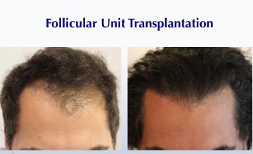 Big Hair #BAM (2222 grafts): Carlos K. Wesley, M.D. (NYC & LA)