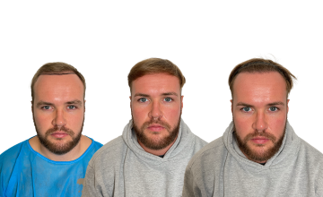 Dr Matt Egan - 3047 Grafts | FUE | Crown and Hairline Touch Up | 12 Month Results