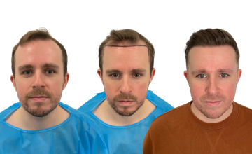 Dr Matt Egan - 2,161 Grafts | FUE | Hairline NWIII | 12 Months