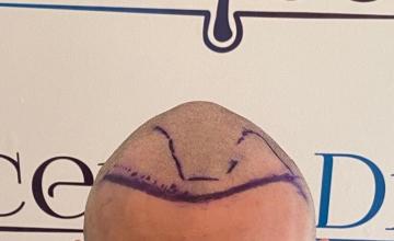 Ozlem Bicer MD-Hair Transplant-2650 Grafts, Manual FUE , 12. months result