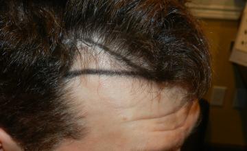 Dr. Diep FUE 1,542 Hair Grafts To Fill both Corners for Receding Hairline